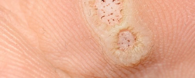 Close-up of a plantar wart on the sole of a foot showing its characteristic appearance